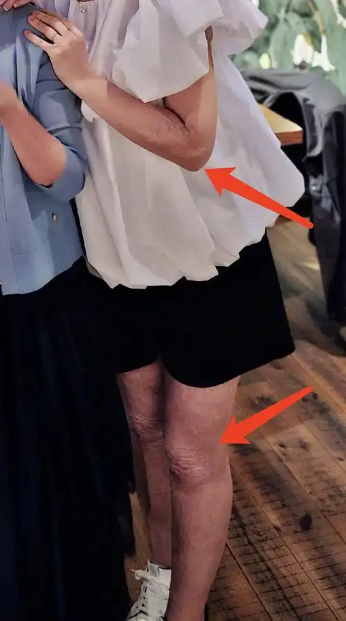 任家萱罕见穿短裤 露双腿烧伤疤痕令粉丝直呼心疼插图5