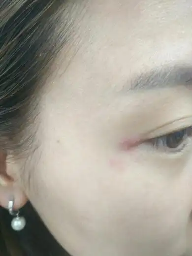 右边外眼角很痒,有小疙瘩是什么情况啊?