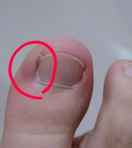 有得过甲沟炎的姐妹吗!(有图慎入)