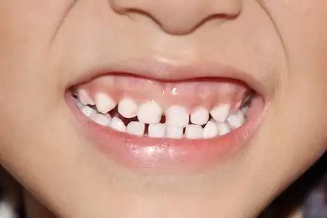 你家孩子笑的时候也露牙龈吗?牙医说,这得治!