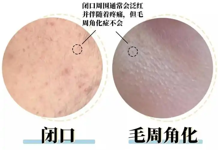 毛周角化症一般不需你好,毛周角化症一般不需要特殊治疗