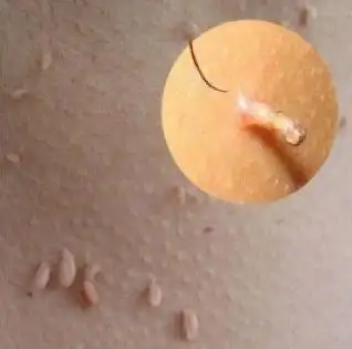 腋窝下为何容易长小肉粒这些小肉粒是什么对身体有影响吗