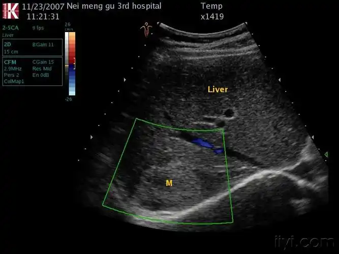 肝血管瘤 - 超声医学讨论版 - 爱爱医医学论坛