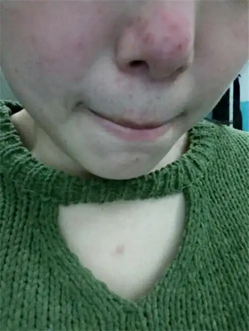 酒糟鼻医院_治疗酒糟鼻哪家医院好_治疗酒糟鼻最好的医院/排行_有来医