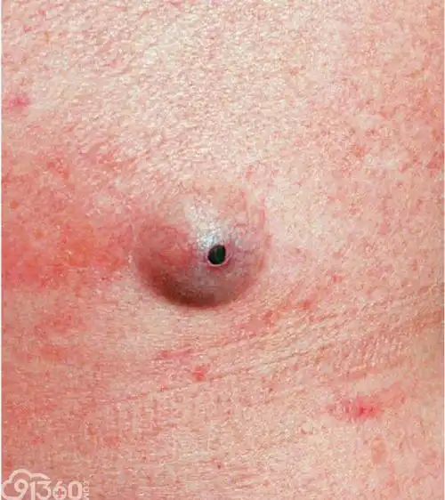 表皮样囊肿临床表现