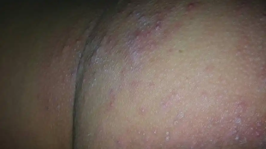 晚上每到十点之十一点之间身体就会发痒,最近屁沟上还起一大片红疙瘩