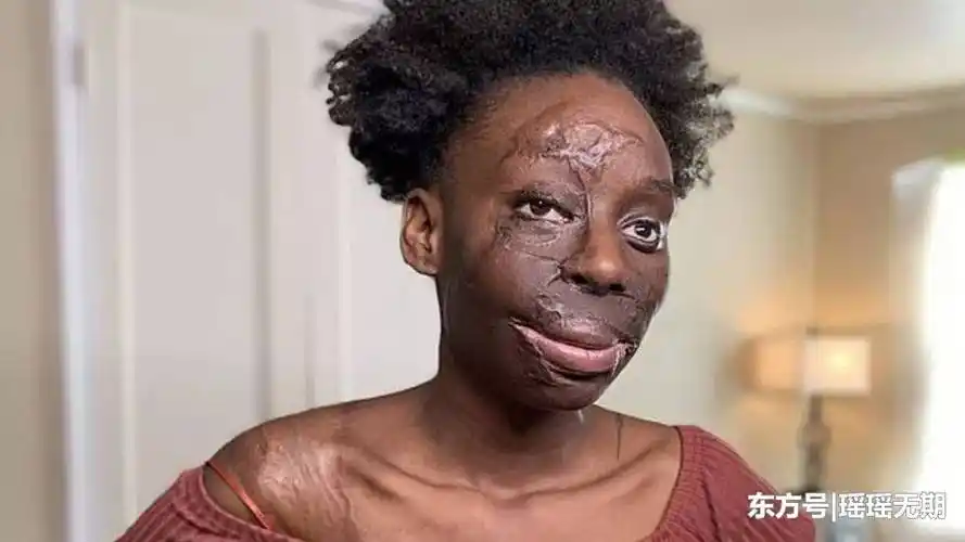 女子身上一半皮肤被烧伤,做过无数次手术,称疤痕像钻石一样珍贵