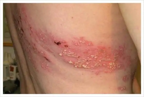 蛇盘疮图片 (25)_有来医生