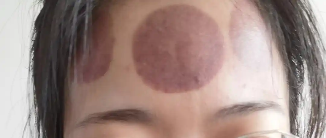 因为不能出门,无聊到在家拔罐养生 然后手贱在头上 拔了罐 而且拔了三