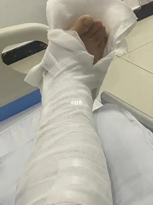 腓骨 后踝骨骨折第四天