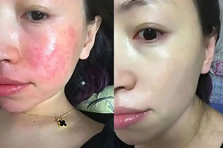 长春哪里可以治疗激素脸