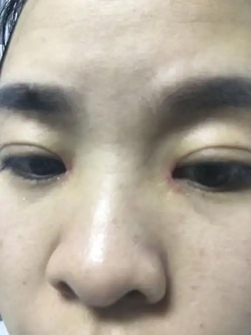 眼角增生两个月了,一直早晚抹芭克,可是效果不大,不知道会不会好?