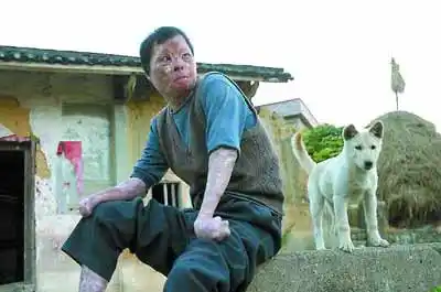 世界上烧伤最严重者讲述16年间心酸事(附图)