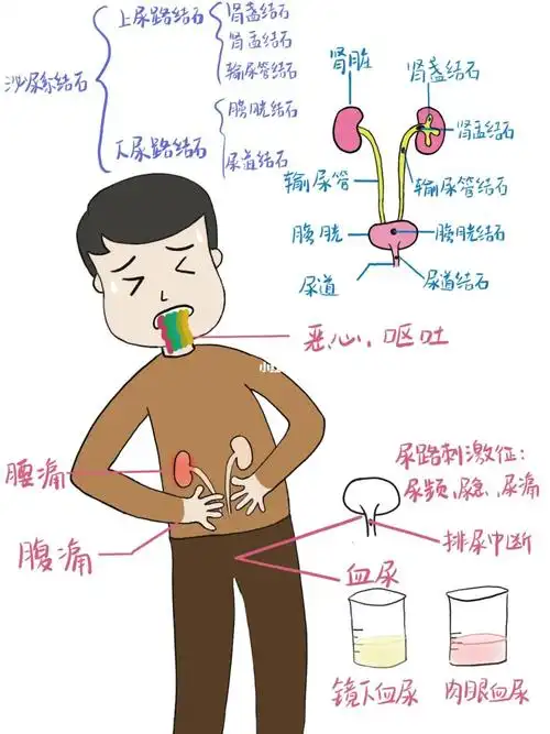 本人曾"有幸"经历过肾结石77输尿管结石06,所以对于泌尿系结石来