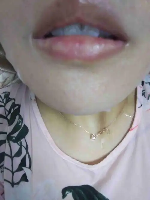 嘴唇上的白斑是什么?