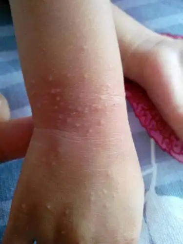 问:宝宝两岁了,手上起的什么疙瘩?