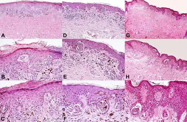 手把手教程:黑色素瘤的特殊皮肤镜表现
