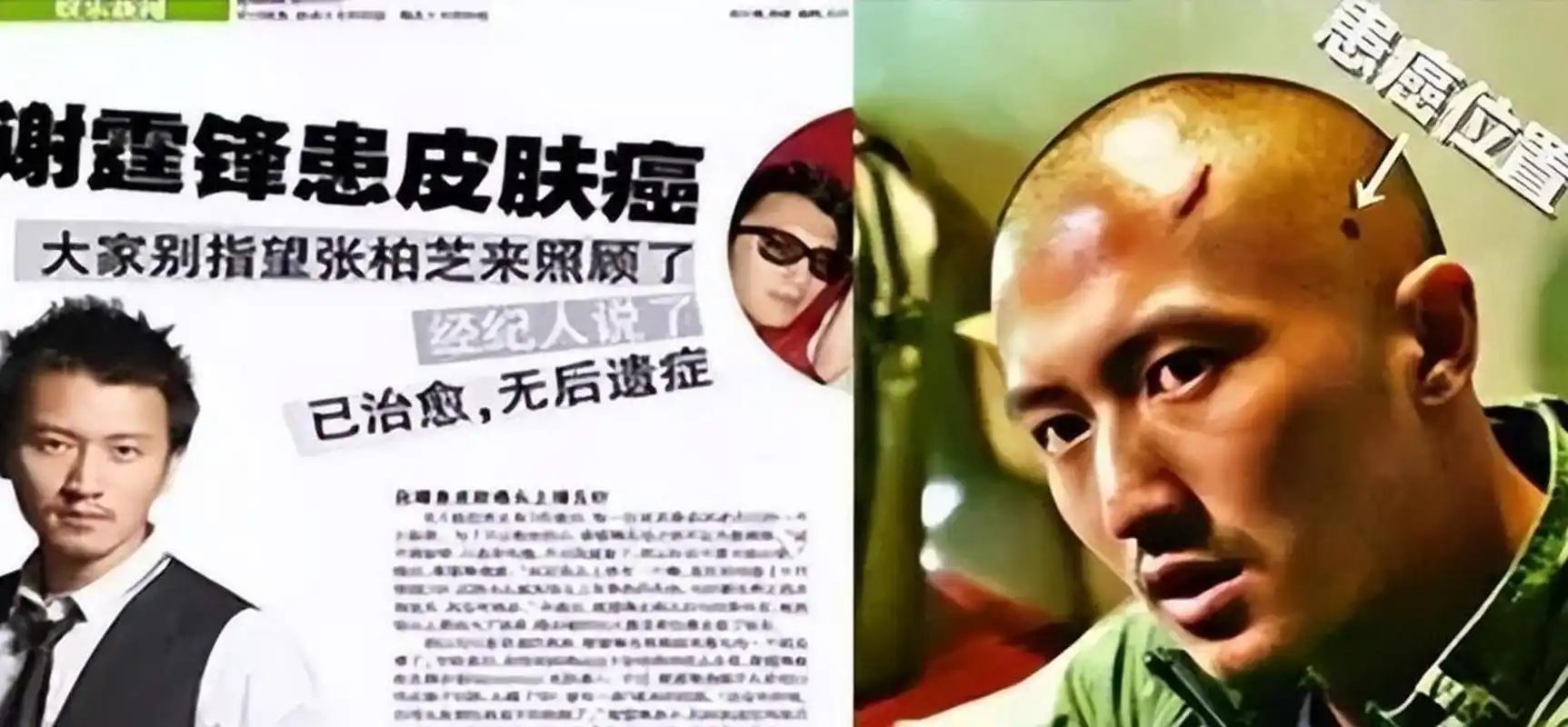 因拍戏需要剃光头意外发现头上的痣,确诊了早期皮肤癌继而治愈,谢霆锋