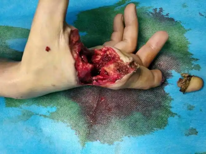 一男性患者,因工作期间疲劳操作致右手掌不全离断及示指末节挤轧性离