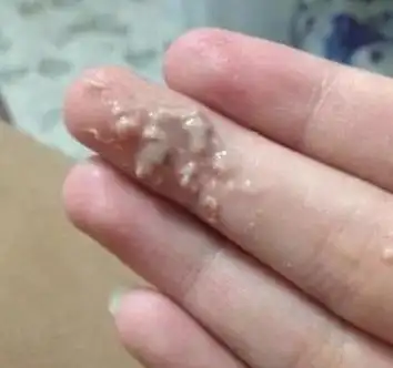 霉菌性阴道炎反复发作太烦人女性益生菌来帮您