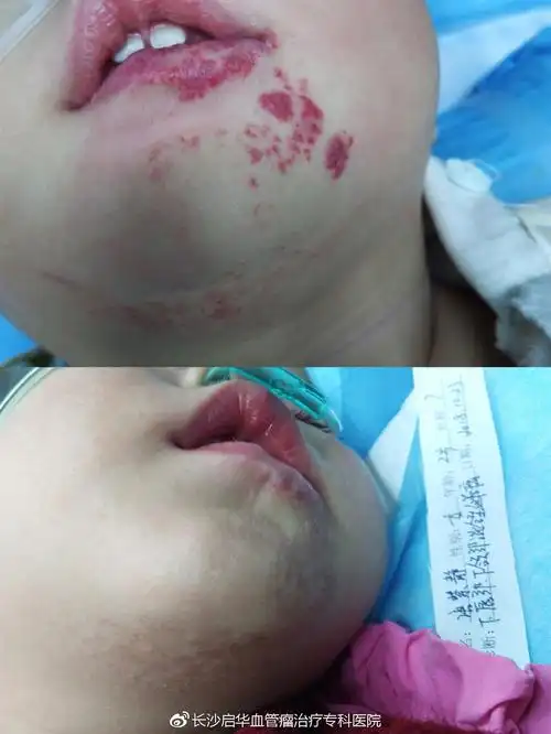 婴儿下唇长红米粒早治疗血管瘤可治愈
