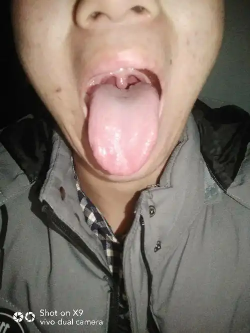 最近似乎感冒,咳嗽时后脑勺也会伴随着咳嗽痛,悬雍垂感觉肿大,喉咙不