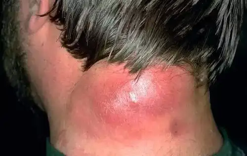 痈疖疔疮的症状和治疗