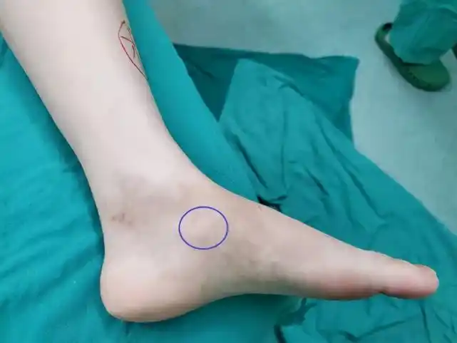 孩子运动后足内侧疼痛足副舟骨问题家长们要警惕