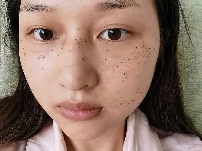96年女脸上真皮斑黄褐斑雀斑