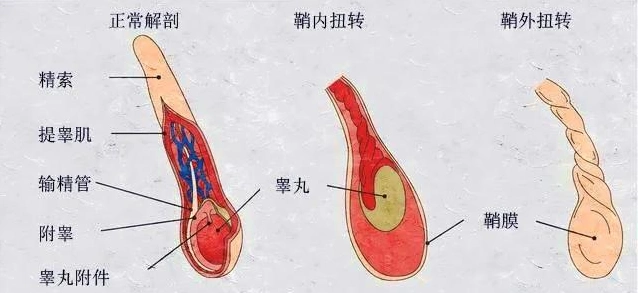 反复阴囊坠胀感或疼痛,触摸阴囊发现附睾肿大,变硬,怎么回事?