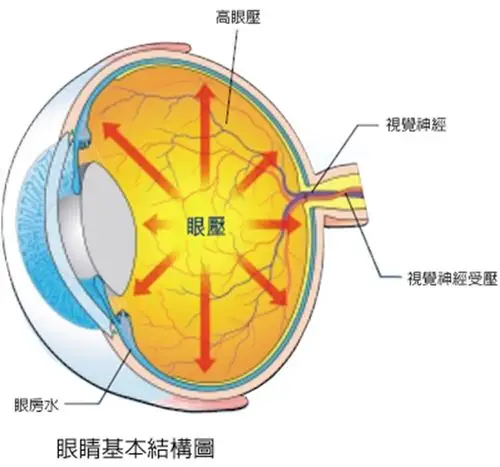 老年青光眼征兆图片