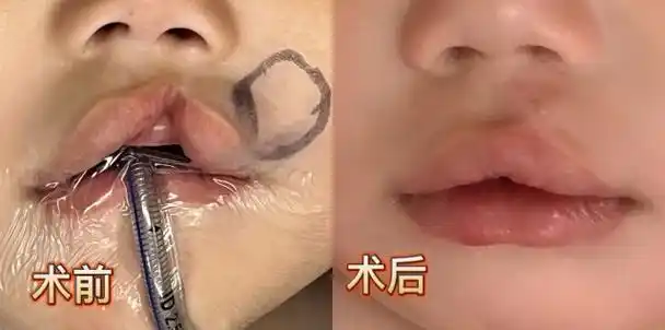8个月"兔唇宝宝"在显微镜下留住珍贵笑容