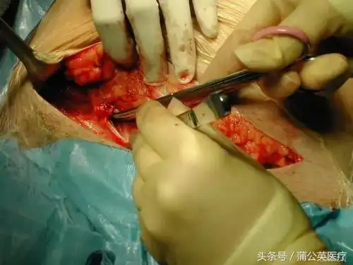 见过剖腹产,你还觉得生孩子简单吗?