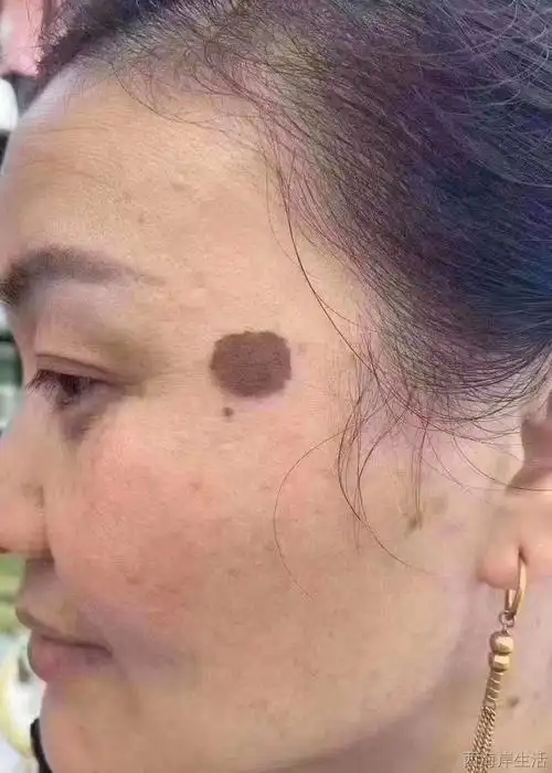 脸上有痣 斑,会阻挡财运. 不管女人男人,古