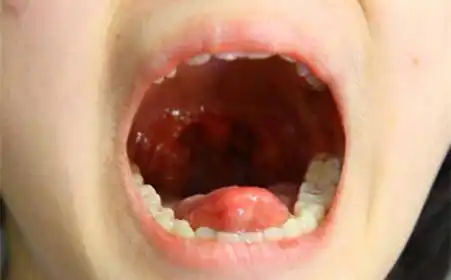 三岁孩子扁桃体三度肿大严重吗四岁扁桃体2度肿大要不要切除