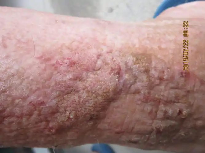 还是什么病? - 皮肤及性传播疾病讨论版 - 爱爱医医学论坛