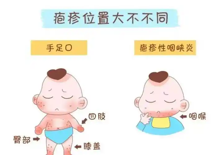 疱疹性咽颊炎预防知识与措施_咽峡炎_孩子_隔离