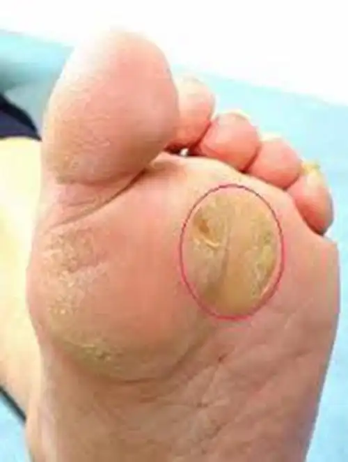 胼胝红色的图片