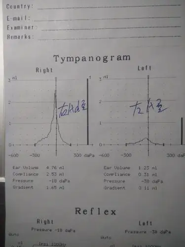 请医生帮我看下这张声导抗检查图