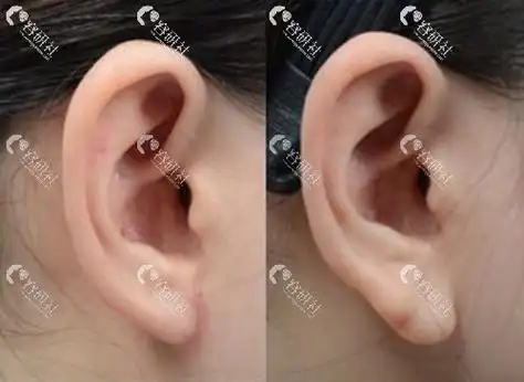 玻尿酸丰耳垂危险吗?术后会不会导致栓塞?