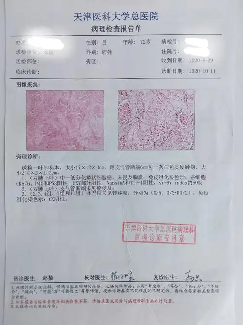 刘懿博士说肺癌(一五〇九)抽一辈子烟肺结节迟迟不住院原来在发脾气