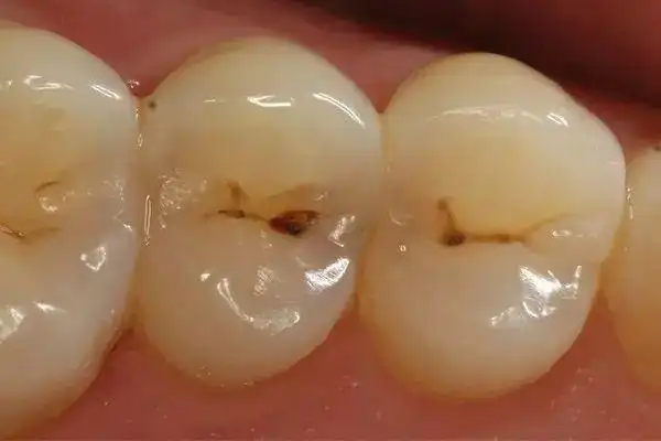 "小黑点"没有及时修补,就会逐渐发展成"中龋".