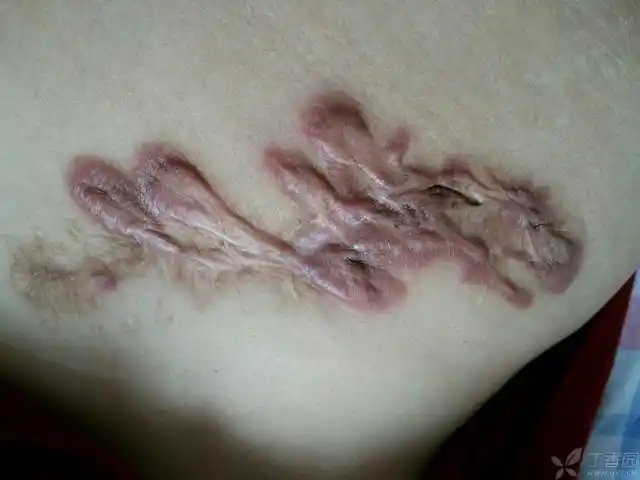 结石行胆囊切除术,术后切口一直愈合不佳,常常有分泌物流出,切口疤痕