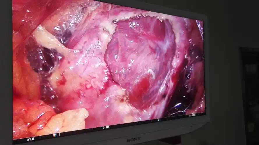 雄安新区容城县医院外一科成功为一位左侧巨大肾囊肿患者行腹腔镜肾