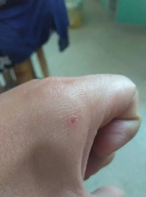 被狗咬这个伤口会有什么问题吗?要的时候我用肥皂水洗,挤压伤口