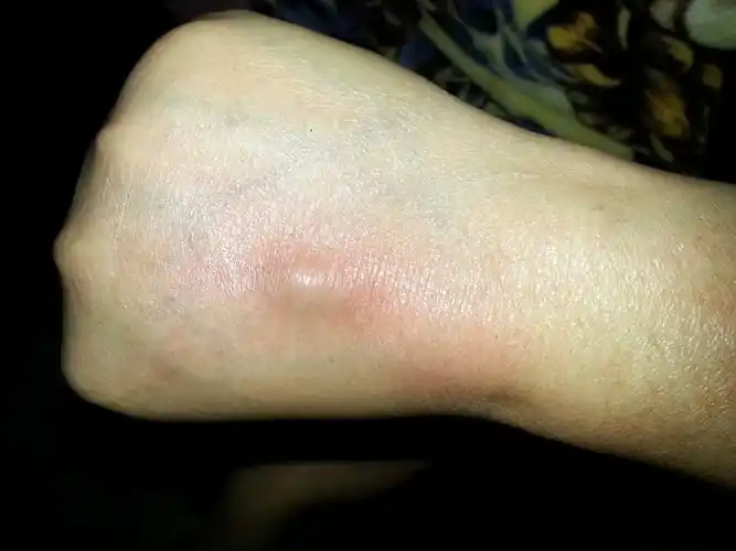 手背骨头长个包