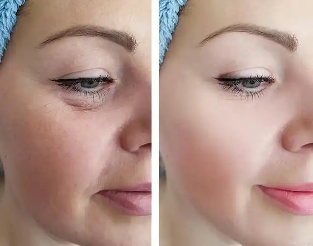 此外,肾病,妊娠期,睡眠不足以及熬夜疲劳也可能导致眼部浮肿,形成眼袋