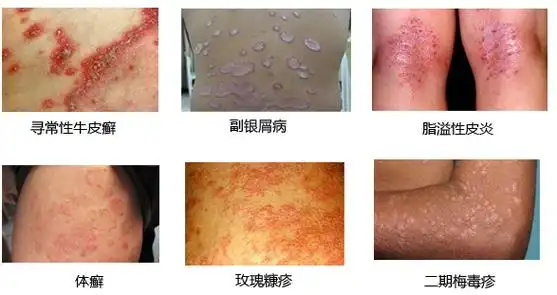 皮肤癣遗传规律与机率_成都银康银屑病医院