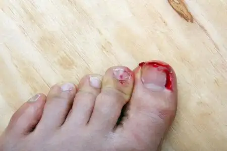 瘭破出血指甲照片