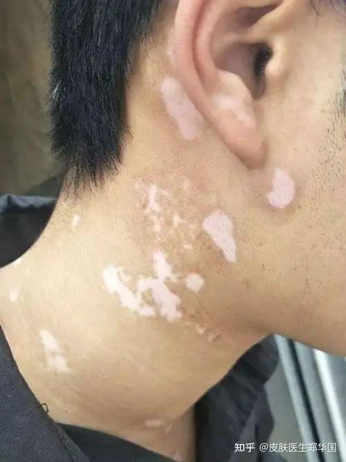 白斑病所表现的皮肤颜色有哪些区别